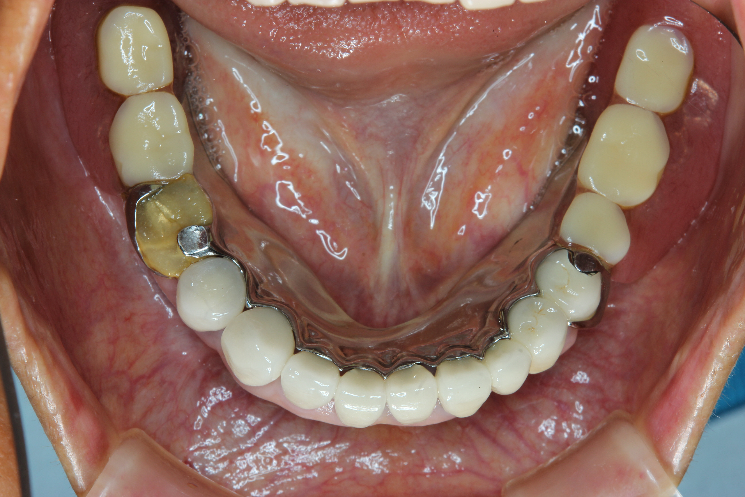 チタンを用いた金属床義歯 入れ歯 石神井公園 歯医者 たけのうち歯科クリニック